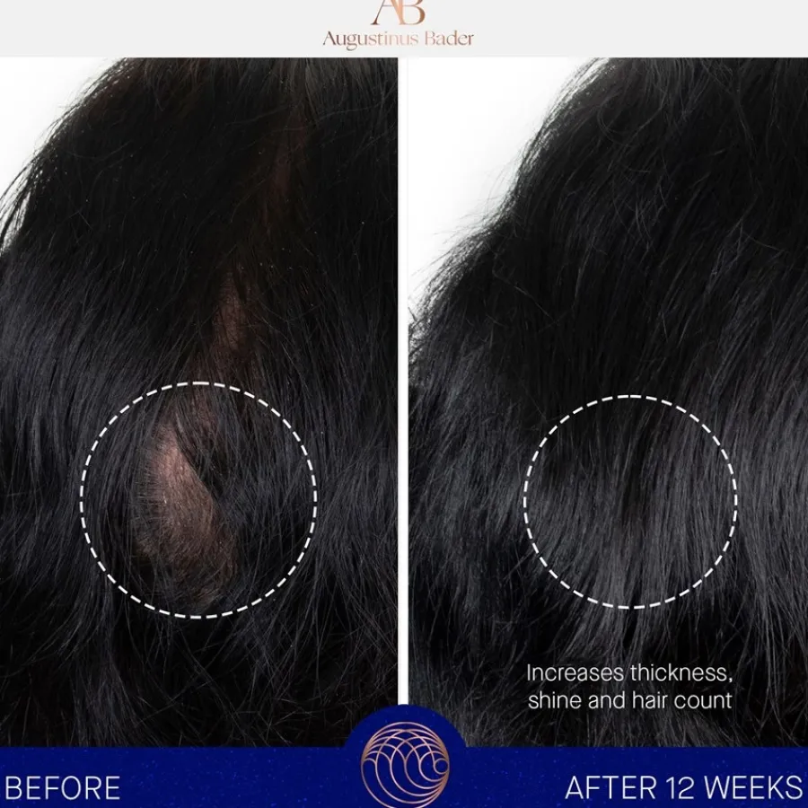 Augustinus Bader The Scalp Treatment