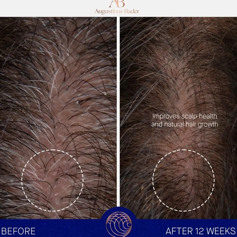 Augustinus Bader The Scalp Treatment