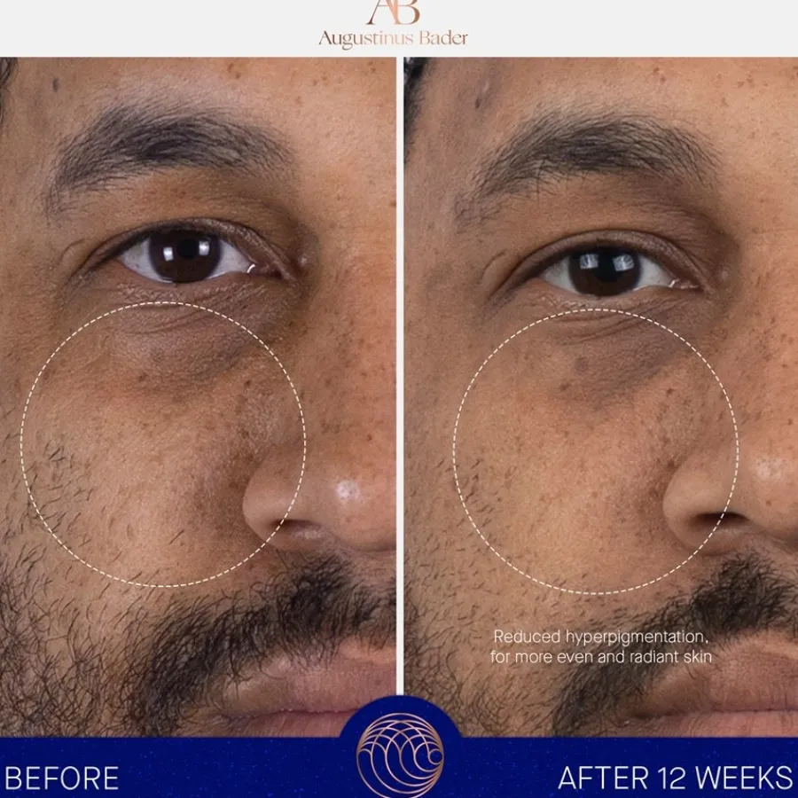 Augustinus Bader Gesicht The Serum von Clearance