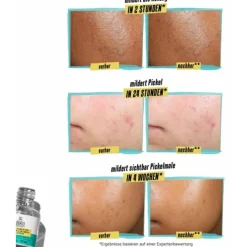 Kiehlu0027s Kiehl's Truly Targeted Blemish Clearing Solution Hot