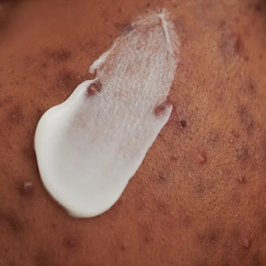 DADO SENS PURDERM EFFEKTCREME - bei unreiner Haut von