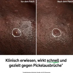 The INKEY List Hydrocolloid Invisible Pimple Patches