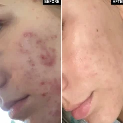 The INKEY List Succinic Acid Treatment Hot